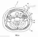Fig. 07 - METHODS AND DEVICES FOR CRYOGENIC CAROTID BODY ABLATION
