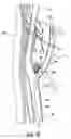 Fig. 22 - METHODS AND DEVICES FOR CRYOGENIC CAROTID BODY ABLATION