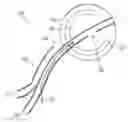 Fig. 01 - BLADDER TISSUE MODIFICATION FOR OVERACTIVE BLADDER DISORDERS