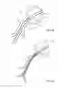 Fig. 06 - BLADDER TISSUE MODIFICATION FOR OVERACTIVE BLADDER DISORDERS