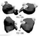 Fig. 09 - Patient-specific virtual intervention laboratory to prevent stroke