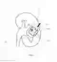 Fig. 09 - Method and system for interactive grid placement and measurements for lesion removal