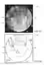 Fig. 04 - Radiopaque procedure site marker and method for intraoperative medical imaging