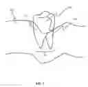 Fig. 08 - System and method for registering implant orientation directly from a dental impression