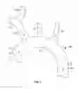 Fig. 02 - EMBOLIC PROTECTION DEVICE