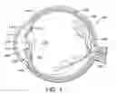 Fig. 02 - Aspherical multifocal intraocular lens