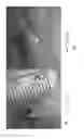 Fig. 02 - Prosthetic devices for semicircular canal defects