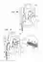 Fig. 04 - Tissue anchor for annuloplasty device