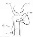 Fig. 01 - Surface replacement implant for the distal humerus