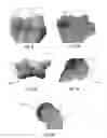 Fig. 03 - Surface replacement implant for the distal humerus