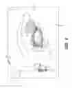 Fig. 04 - NASOLACRIMAL IMPLANTS AND RELATED METHODS FOR TEAR STIMULATION