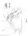 Fig. 03 - Dynamic tensioning orthosis and related method of use