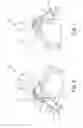 Fig. 07 - Dynamic tensioning orthosis and related method of use
