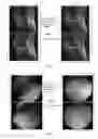 Fig. 06 - COMPOSITION FOR TREATING ARTICULAR CARTILAGE DEFECTS