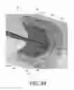 Fig. 83 - System and method for safety syringe