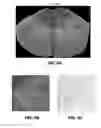 Fig. 07 - Spinal subpial gene delivery system