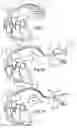 Fig. 07 - Cardiac lead wire protector