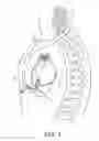 Fig. 02 - Electrode fixation in interventional medical systems