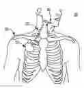 Fig. 01 - Stimulation for treating sleep disordered breathing