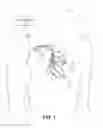 Fig. 02 - Pacemaker mediated tachycardia detection and intervention