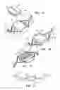 Fig. 02 - Retinal implant fixation