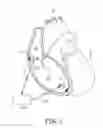 Fig. 02 - Atrial tracking in an intracardiac ventricular pacemaker