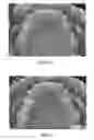 Fig. 22 - INTRA-ORAL LIGHT THERAPY APPARATUSES AND METHODS FOR THEIR USE