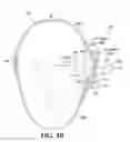 Fig. 18 - Treating degenerative dementia with low intensity focused ultrasound pulsation (LIFUP) device