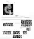 Fig. 07 - Targeting BCL11A distal regulatory elements for fetal hemoglobin reinduction
