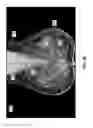 Fig. 09 - Systems and user interfaces for determination of electro magnetically identified lesions as included in medical images of differing perspectives