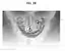 Fig. 08 - Method, apparatus and program for selective registration three-dimensional tooth image data to optical scanning tooth model