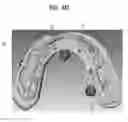 Fig. 15 - Method, apparatus and program for selective registration three-dimensional tooth image data to optical scanning tooth model