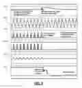 Fig. 06 - Hybrid rectifier circuit for rectifying a line current