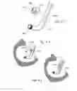 Fig. 10 - Methods and apparatus for treating disorders of the ear nose and throat