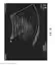 Fig. 06 - Ultrasound system for enhanced instrument visualization