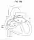 Fig. 17 - Patent foramen ovale closure method