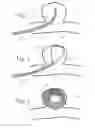 Fig. 02 - Intrasacular Aneurysm Occlusion Device with Mesh-Filled Loops