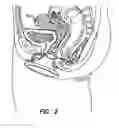 Fig. 03 - Natural orifice surgery system
