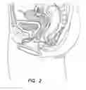 Fig. 03 - NATURAL ORIFICE ACCESS DEVICE