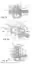 Fig. 06 - Spinal stabilization system with rigid and flexible elements