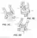 Fig. 09 - Self in-fusing pedicle screw implant