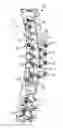 Fig. 01 - Spinal correction and secondary stabilization