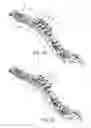 Fig. 10 - Spinal correction and secondary stabilization