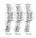 Fig. 11 - Spinal correction and secondary stabilization