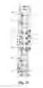Fig. 15 - Spinal correction and secondary stabilization