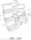 Fig. 11 - Methods, systems and apparatuses for torsional stabilization