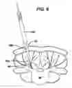 Fig. 08 - Methods and devices for spinal fixation element placement