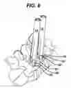 Fig. 10 - Methods and devices for spinal fixation element placement