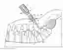 Fig. 01 - Bone anchor receiver with upper tool engaging grooves and planar faces
