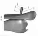 Fig. 100 - Intramedullary fracture fixation devices and methods